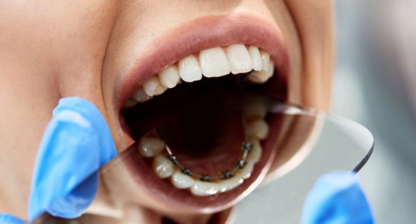 lingual braces cost in india